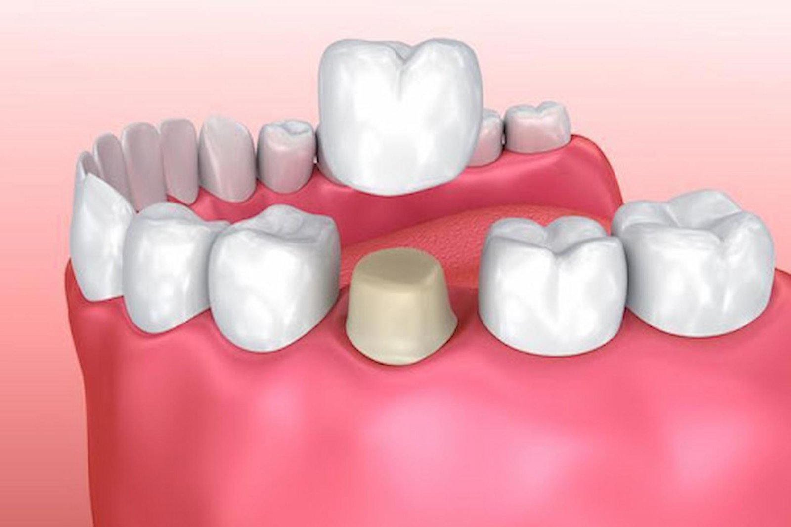 How Dental Crowns Improve Your Oral Health?
