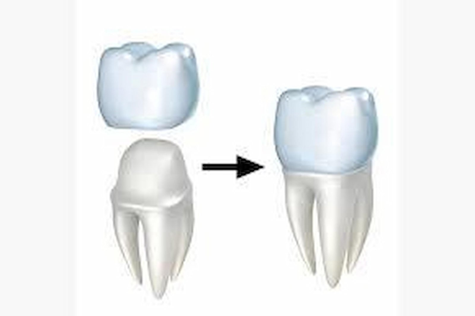 Dental Crowns