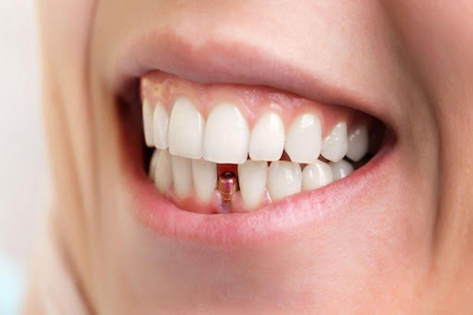The Difference Between Immediate Implant and Other Dental Implant Methods