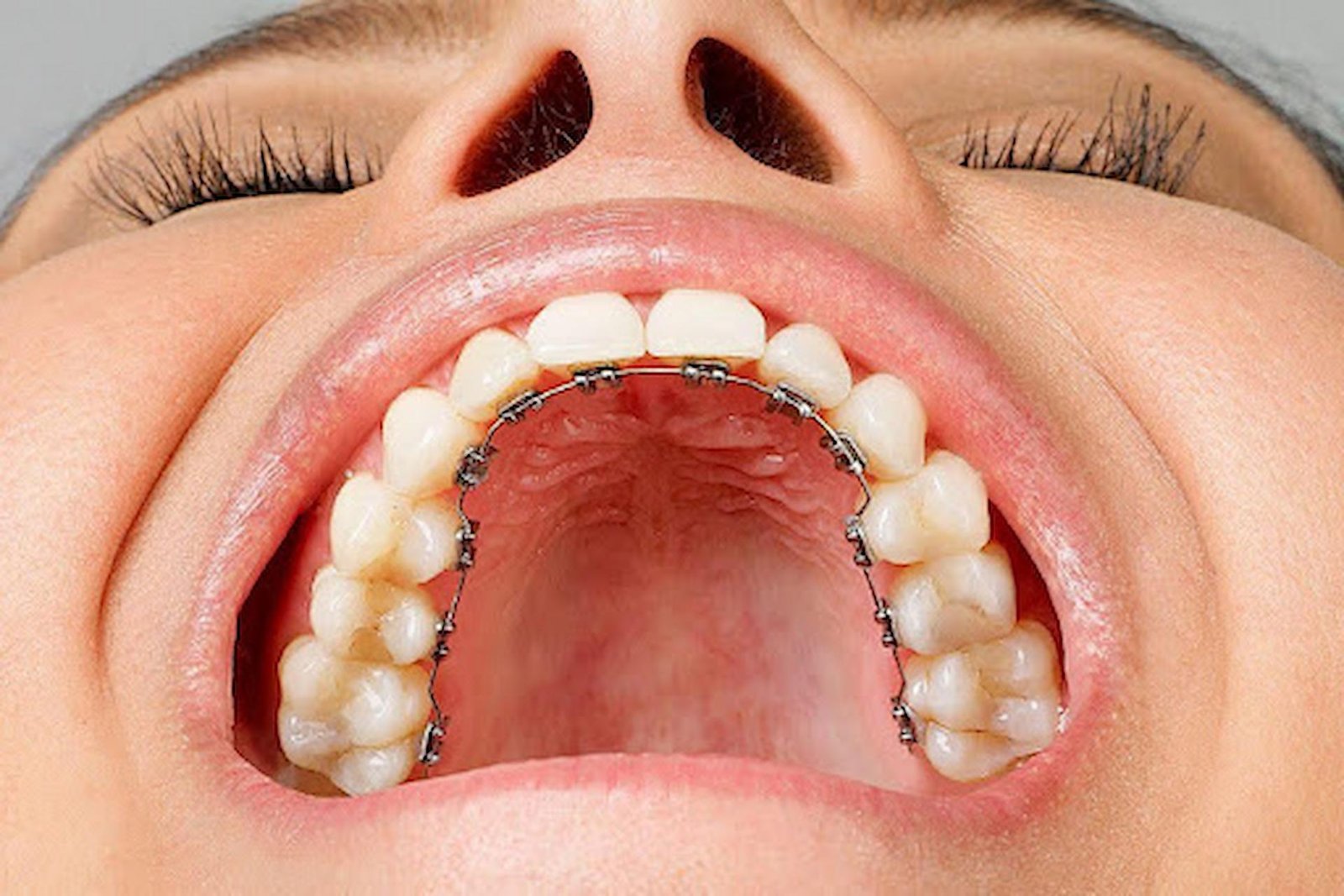 Lingual Braces