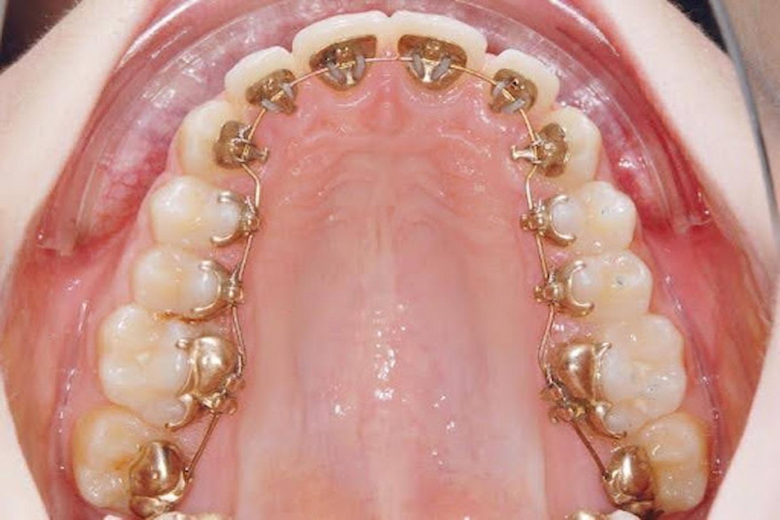 Lingual Orthodontics or Orthodontics Behind the Teeth